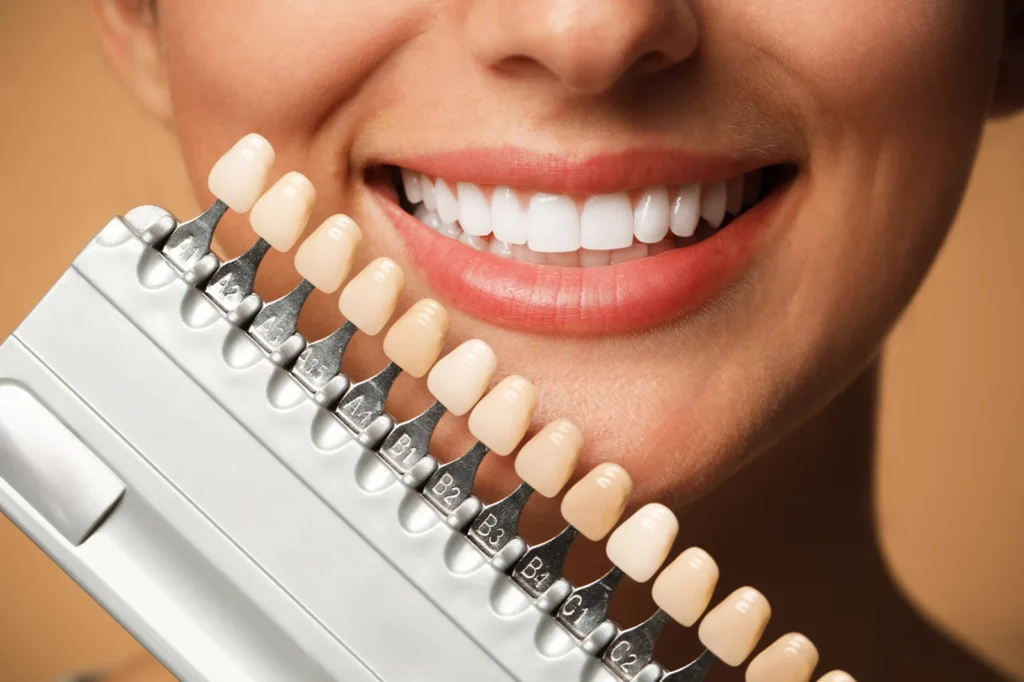 Bestimmung des Ausgangsfarbtons vor dem Zahnbleaching