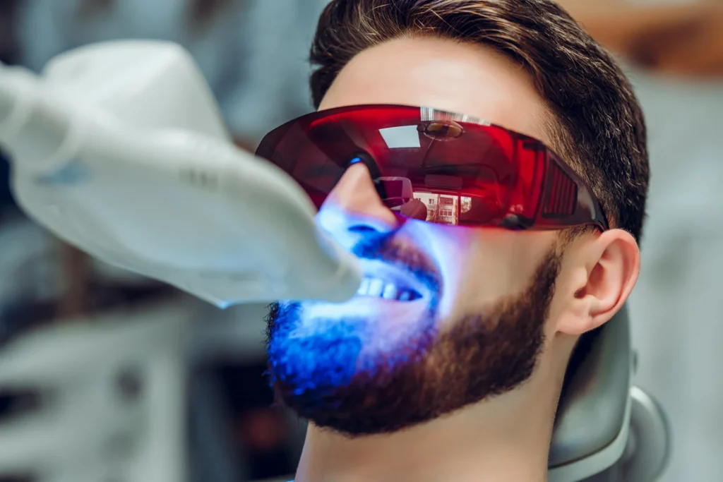 Auftragen des Bleaching-Gels für die kosmetische Zahnaufhellung